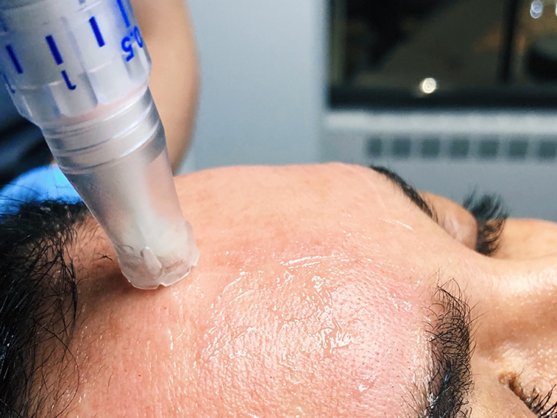 Microneedling
