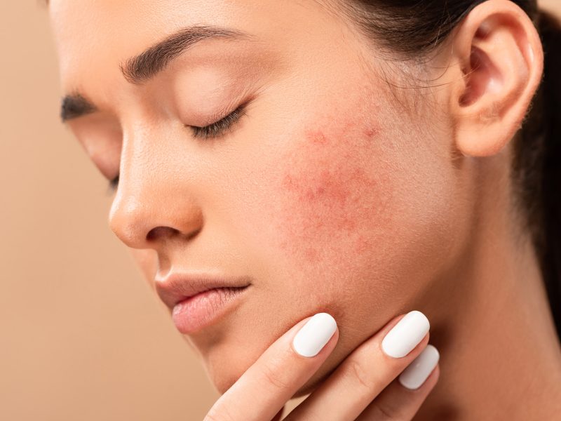 acne treatment